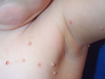 Wart on baby skin